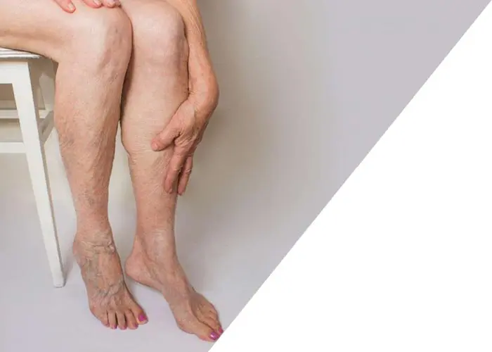 How is Varicose Veins Treatment with Sclerotherapy (Foam)
