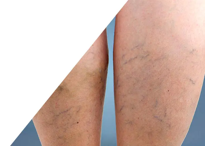 Varicose Veins Treatment with Foam​