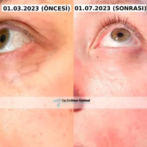 gozalti-varis-tedavisi-oncesi-sonrasii-1