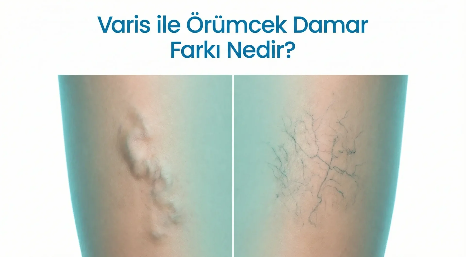 Varis ile örümcek damar arasındaki fark karşılaştırma görseli