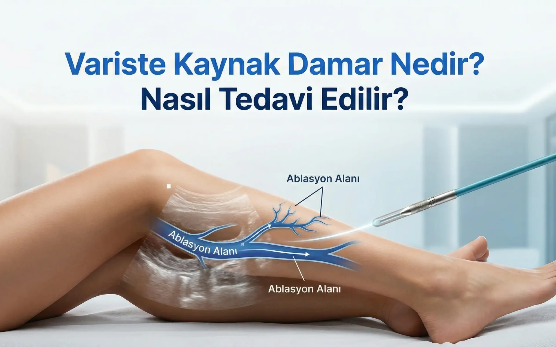 Variste kaynak damar nedir - varis tedavisi İzmir